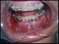 Reattaching_the_lower_gums_jpg